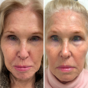 Morpheus8 in Greenwich, CT