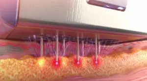 Morpheus8 in Greenwich, CT