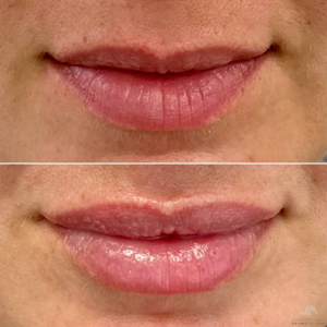 Targeting Volume Loss in Lips