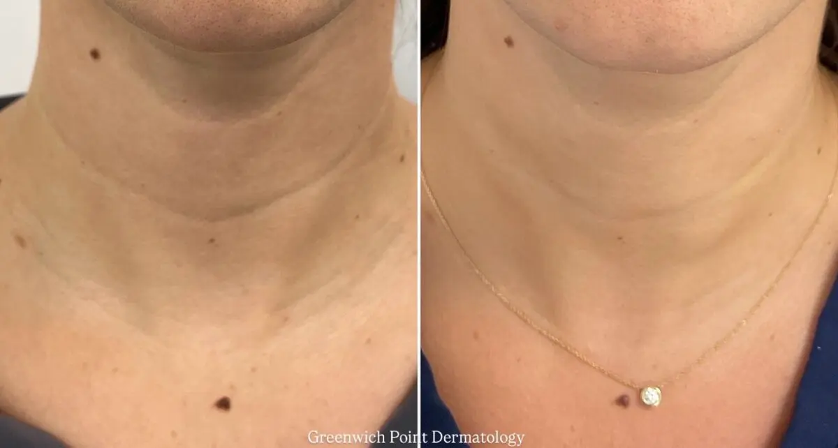 The most effective ways to reverse signs of aging on your neck