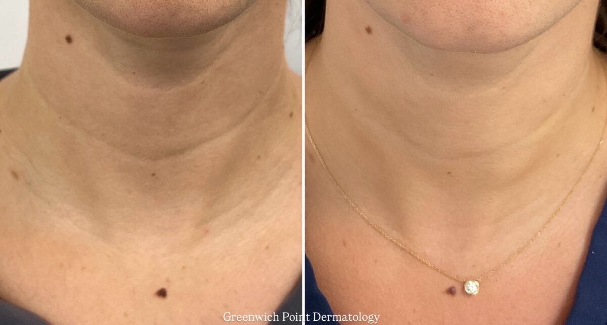 The most effective ways to reverse signs of aging on your neck